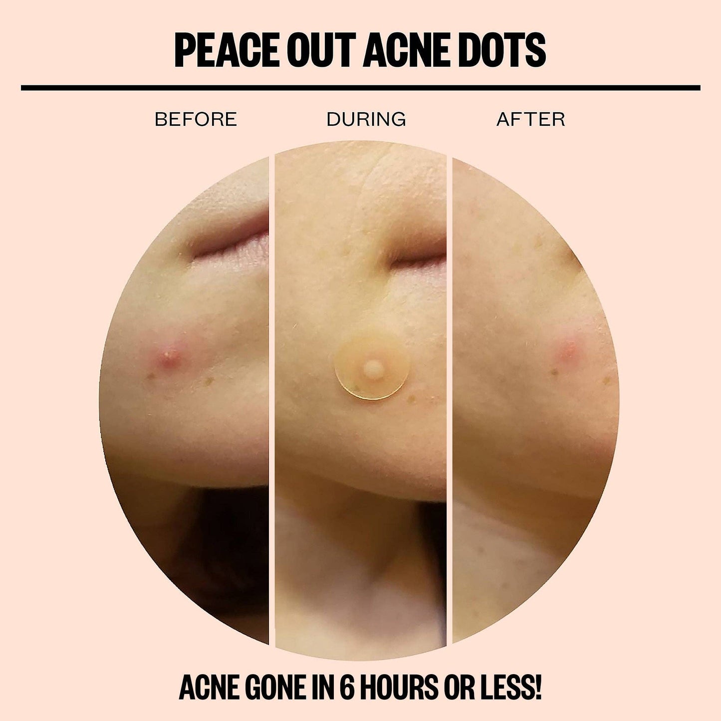 Peace Out Skincare Acne Dots - 10 Pack