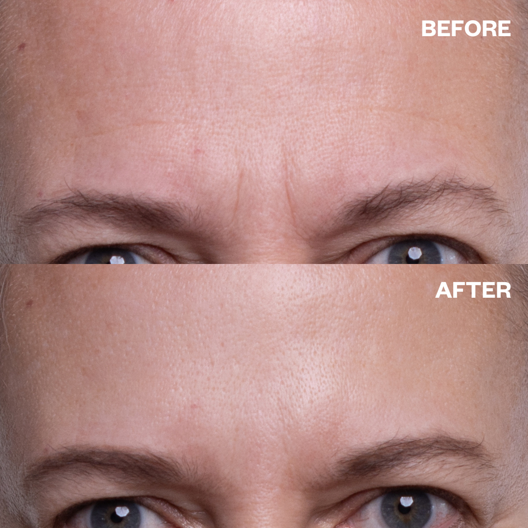 Wrinkles Schminkles Forehead Wrinkle Patches